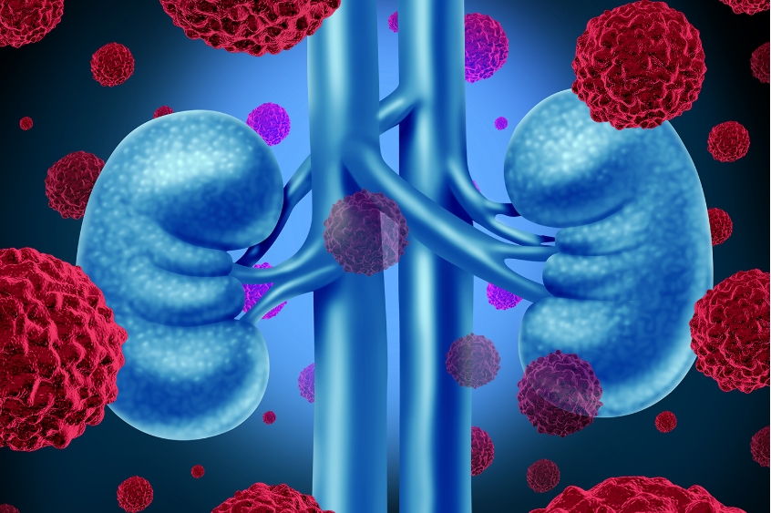 Os avanços no tratamento do câncer renal e a dificuldade de acesso no Brasil